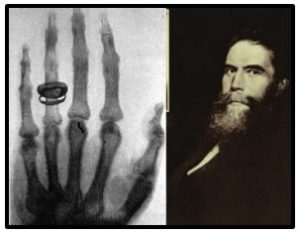 W. Roentgen (1845-1923) y la primera radigrafía de la historia: la de la mano de su esposa